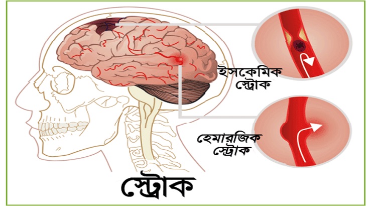 স্ট্রোকের লক্ষণ, দ্রুত করণীয় কী?